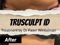 Trusculpt Non-Surgical Fat Loss
